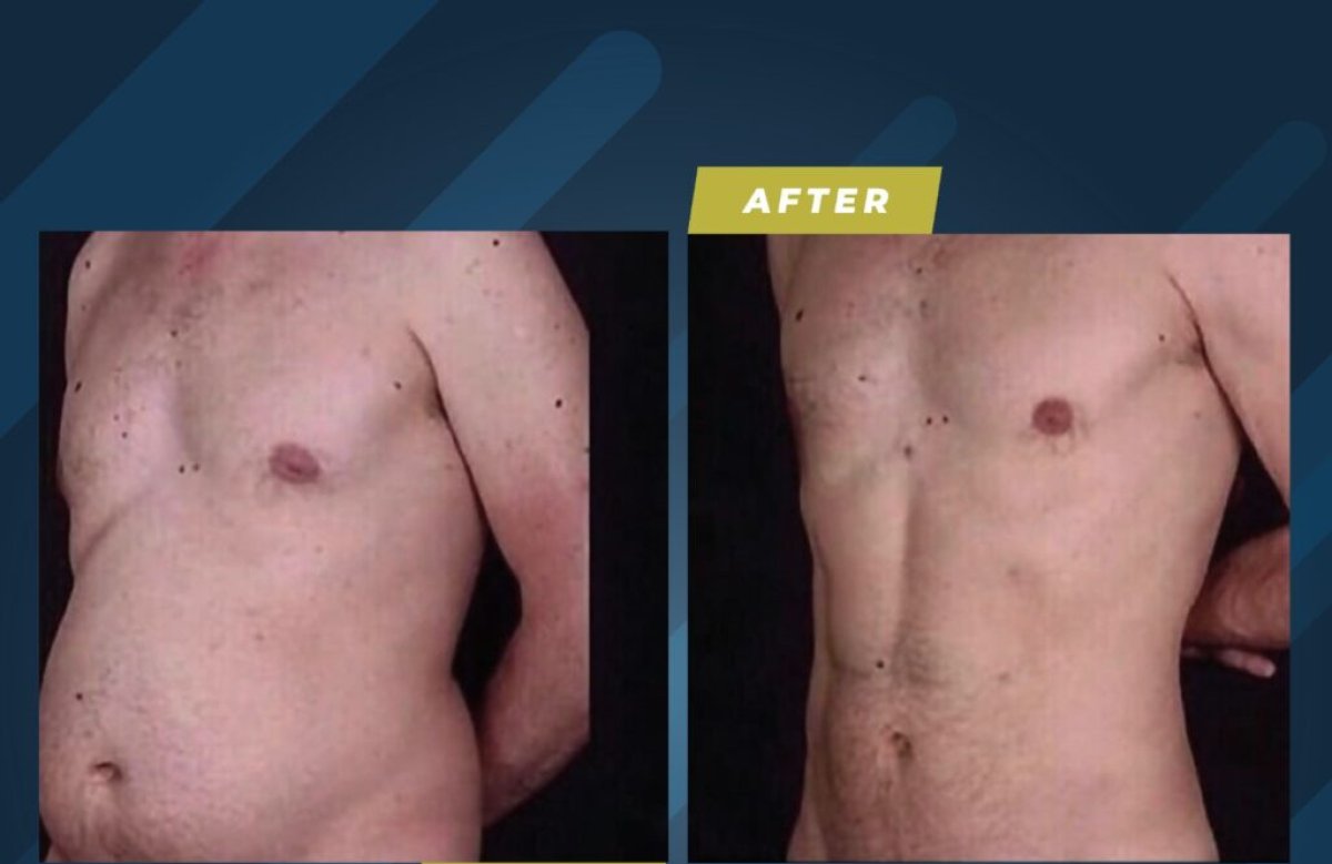 Before and after liposuction results in male patient – visible abdominal contour improvement