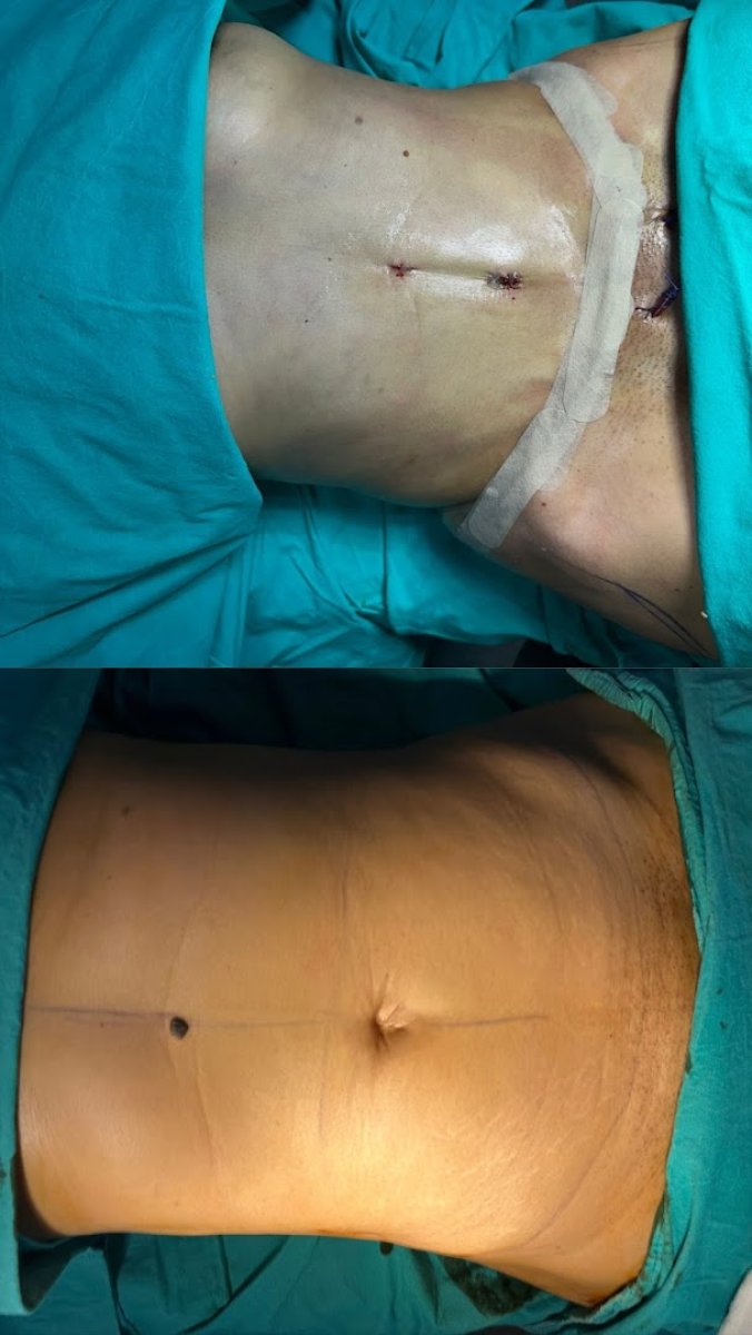 Vorher-nachher-Ergebnis Bauchdeckenstraffung – flacherer Bauch und verbesserte Kontur
