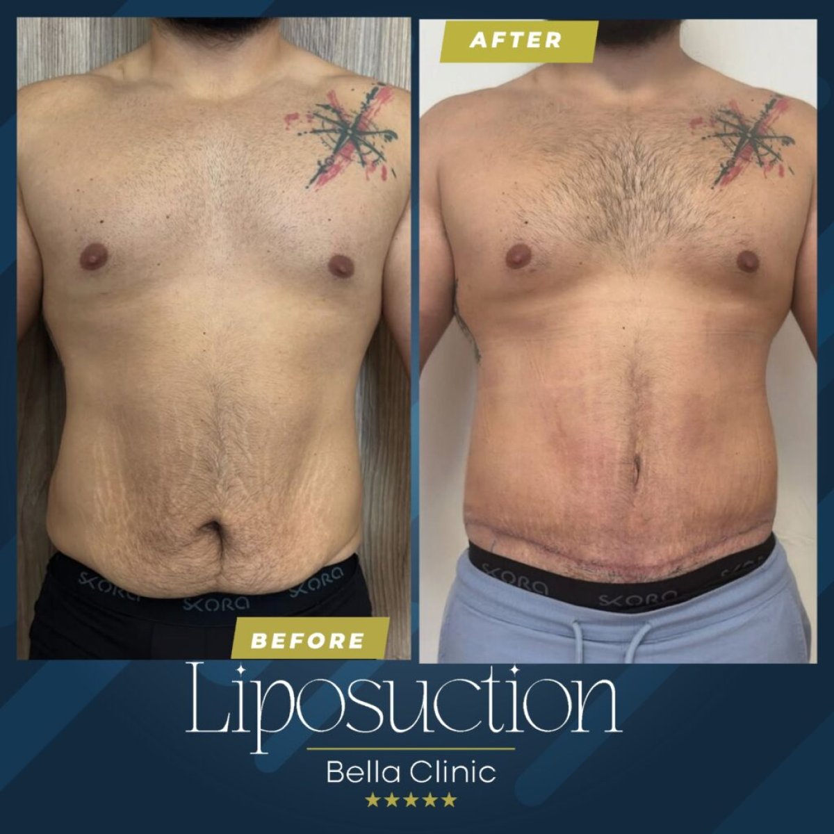 Resultados de liposucción antes y después en Bella Clinic – mejor contorno abdominal masculino