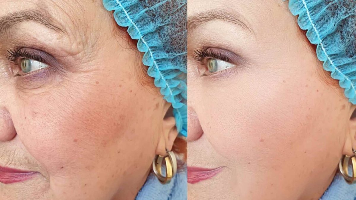 Resultados de blefaroplastia antes y después – menos arrugas y piel más suave en los ojos