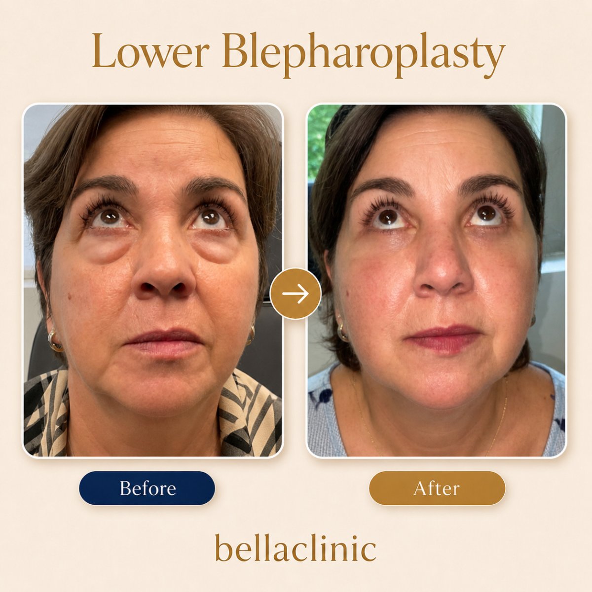 Before and after lower blepharoplasty results at bellaclinic, under-eye bag removal