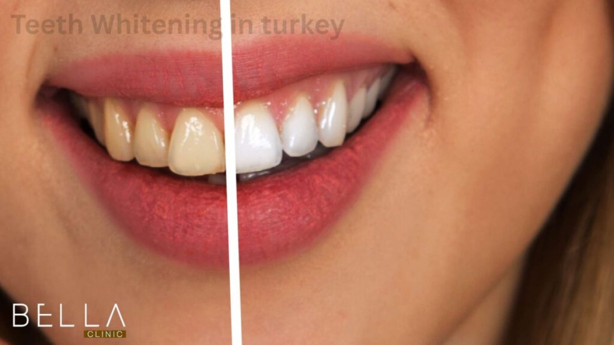 Resultado de blanqueamiento dental antes y después en Bella Clinic, sonrisa más brillante