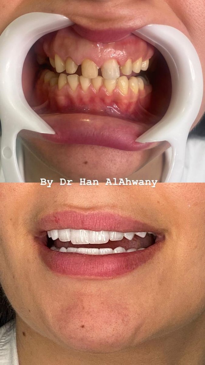 Antes y después de carillas dentales con Dr Han AlAhwany – sonrisa natural y renovada