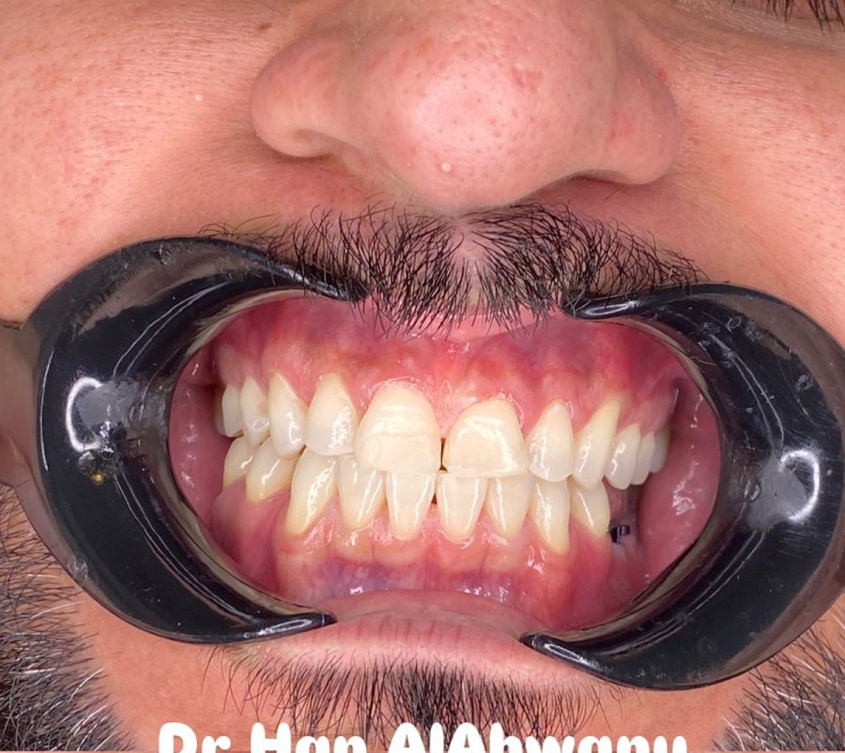Resultado de tratamiento Invisalign con alineación dental mejorada y corrección de sonrisa