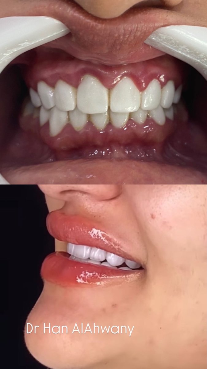 نتائج قبل وبعد تقويم Invisalign مع د. هان الأحواني – تحسين ترتيب الأسنان والابتسامة