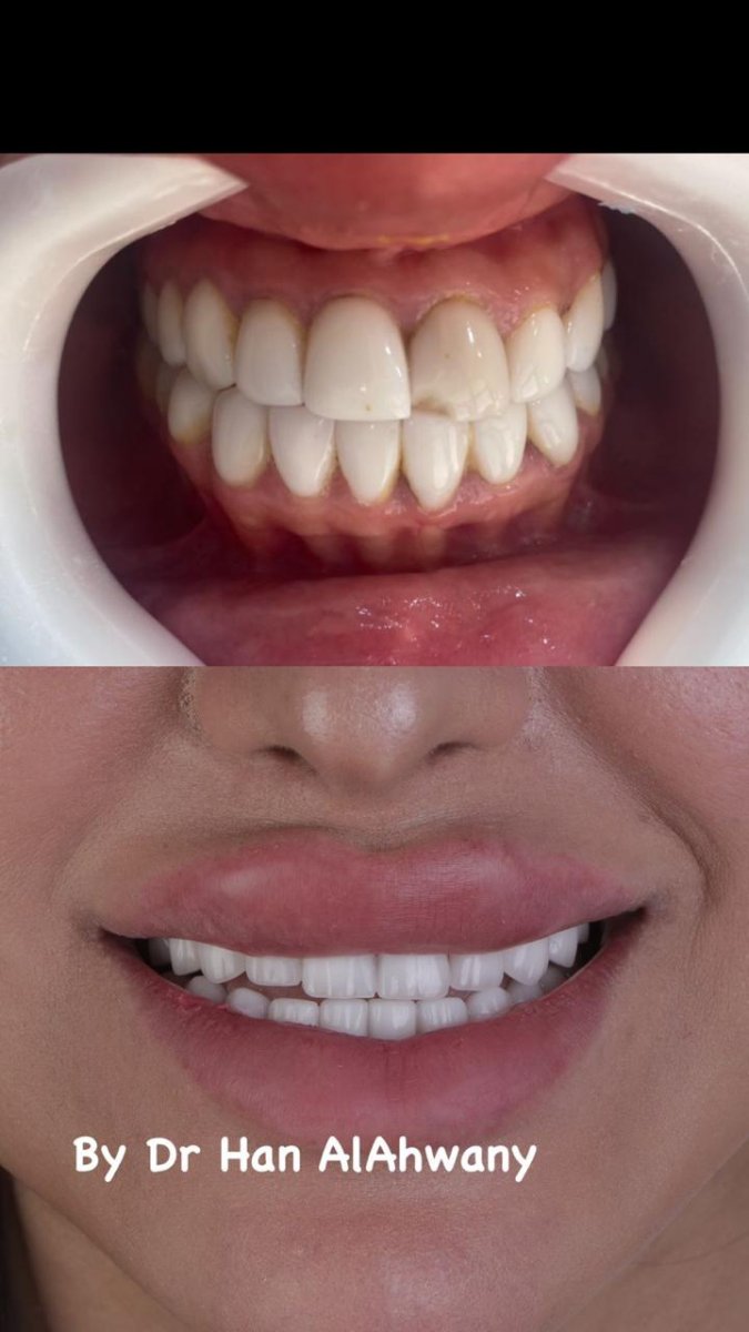 Resultado de carillas antes y después por Dr Han AlAhwany – sonrisa mejorada y dientes blancos