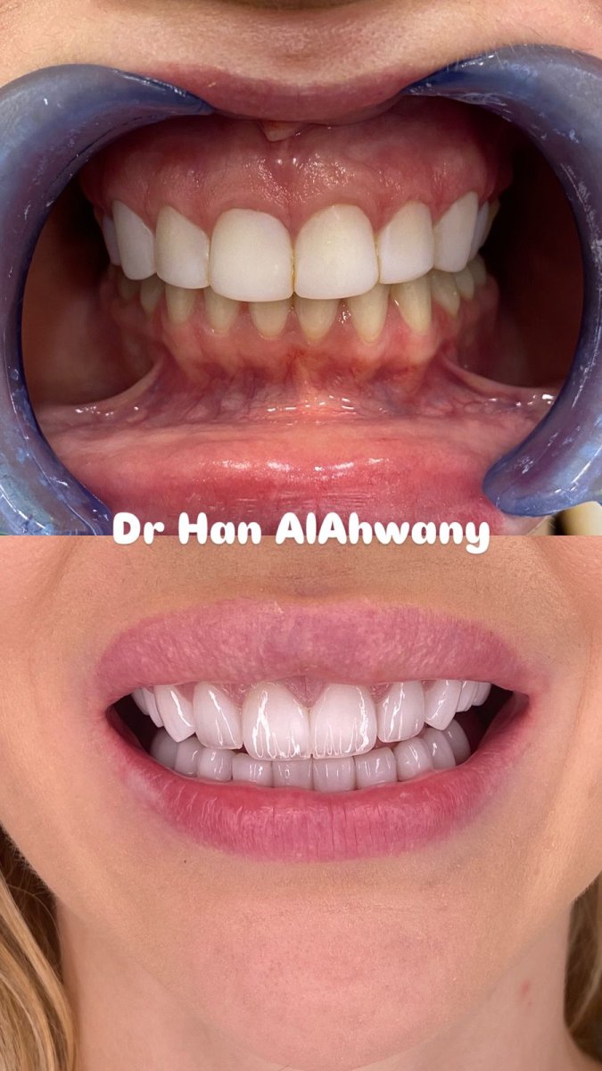 Resultado antes y después de carillas dentales con Dr Han AlAhwany – transformación de sonrisa