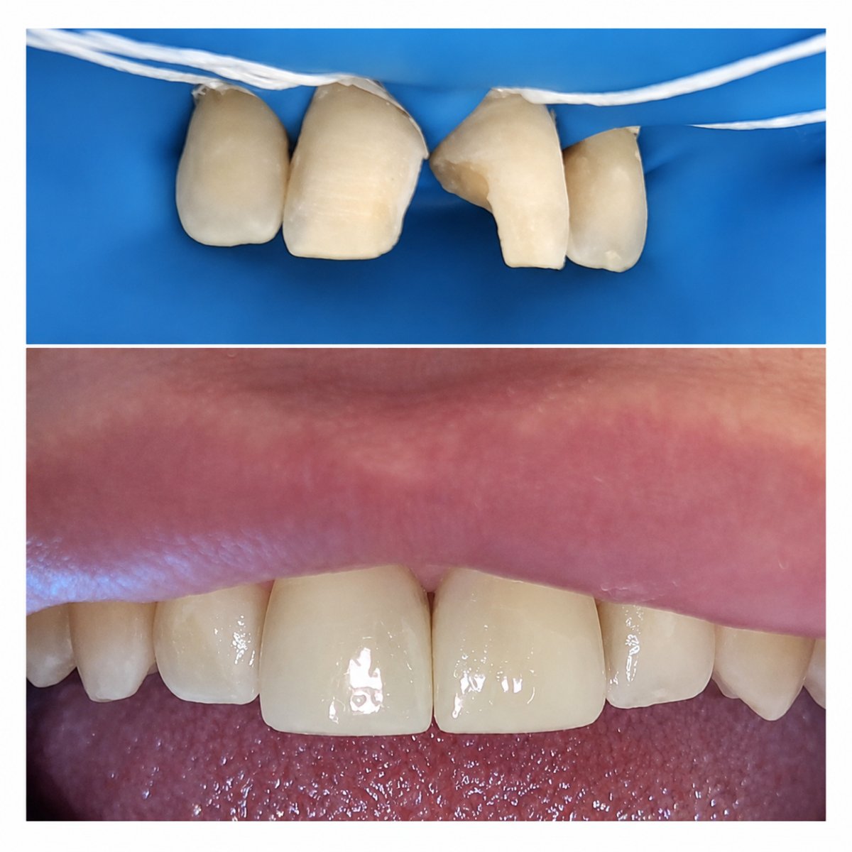 Before and after aesthetic composite filling results at Spanderashvili Dental Clinic