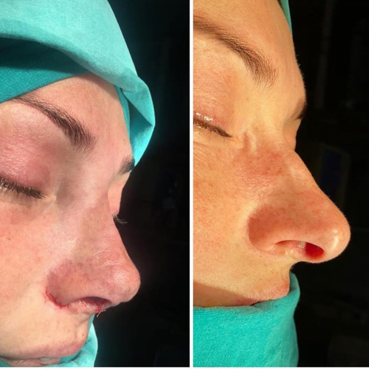 Before and after septoplasty results for deviated septum correction, improved nasal shape