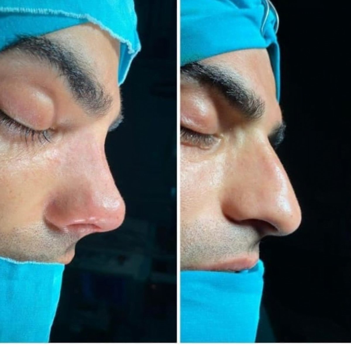 Résultats avant et après septoplastie, profil nasal amélioré après chirurgie
