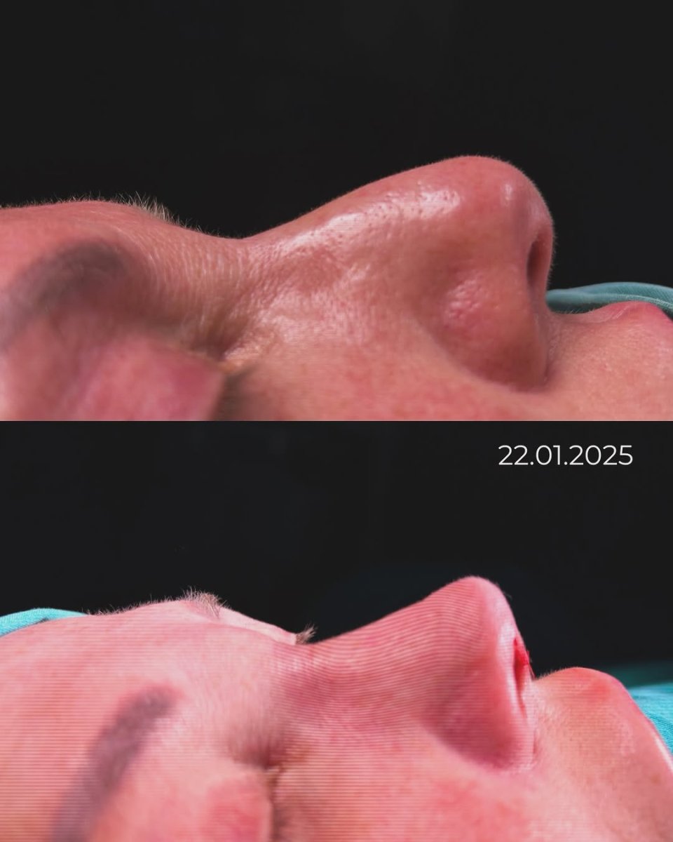 Before and after septoplasty results for deviated septum correction, improved nasal profile