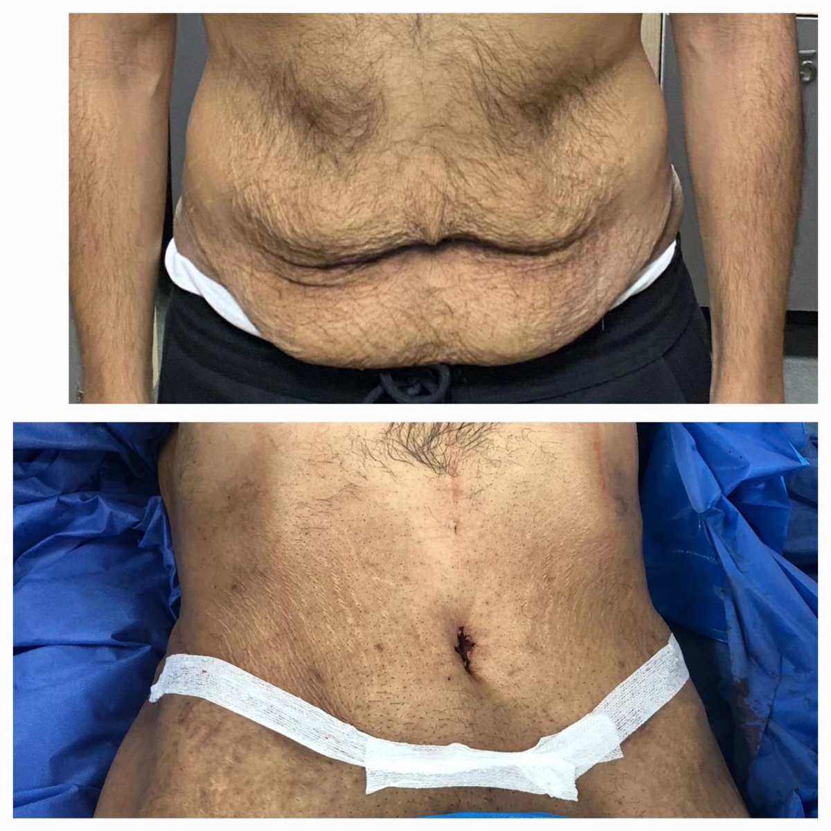 نتائج قبل وبعد جراحة التجميل بعد البدانة – تحسين شكل البطن