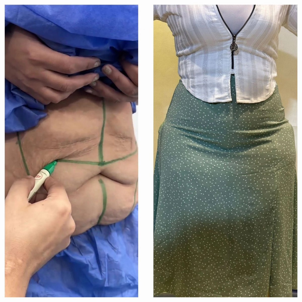 Before and after post-bariatric plastic surgery results – improved abdominal contour
