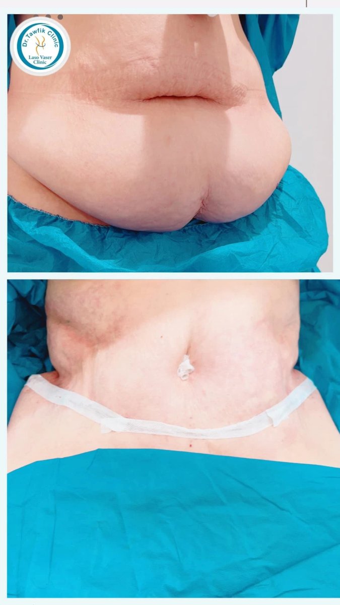 Resultados de abdominoplastia post-bariátrica en Dr. Tawfik Clinic: abdomen mejorado