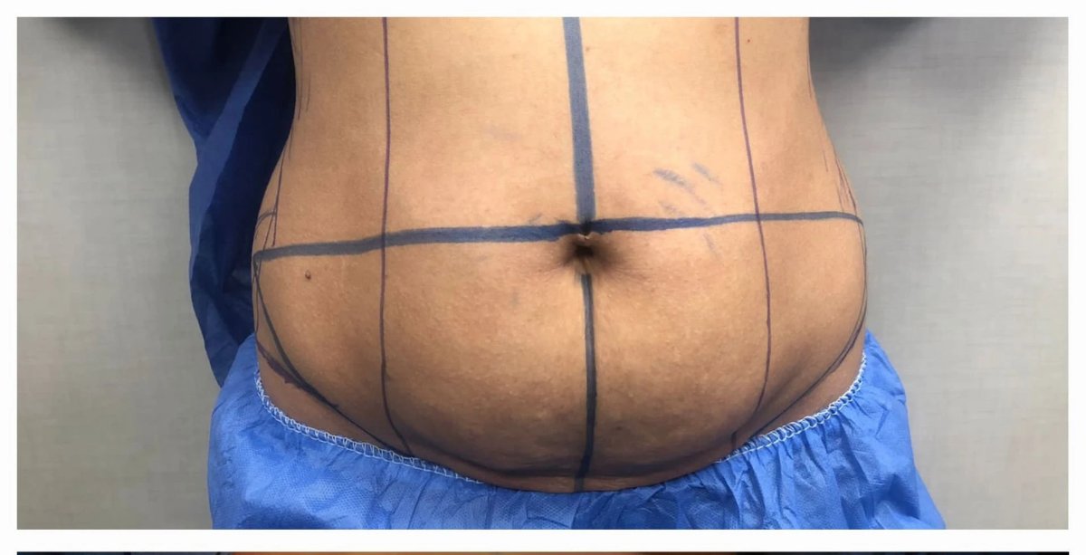 بطن مع علامات قبل جراحة التجميل بعد السمنة لتنسيق القوام