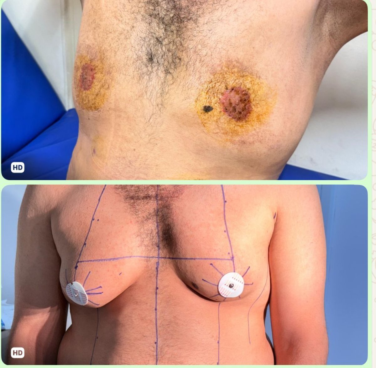 Before and after gynecomastia surgery results, male chest contour improvement