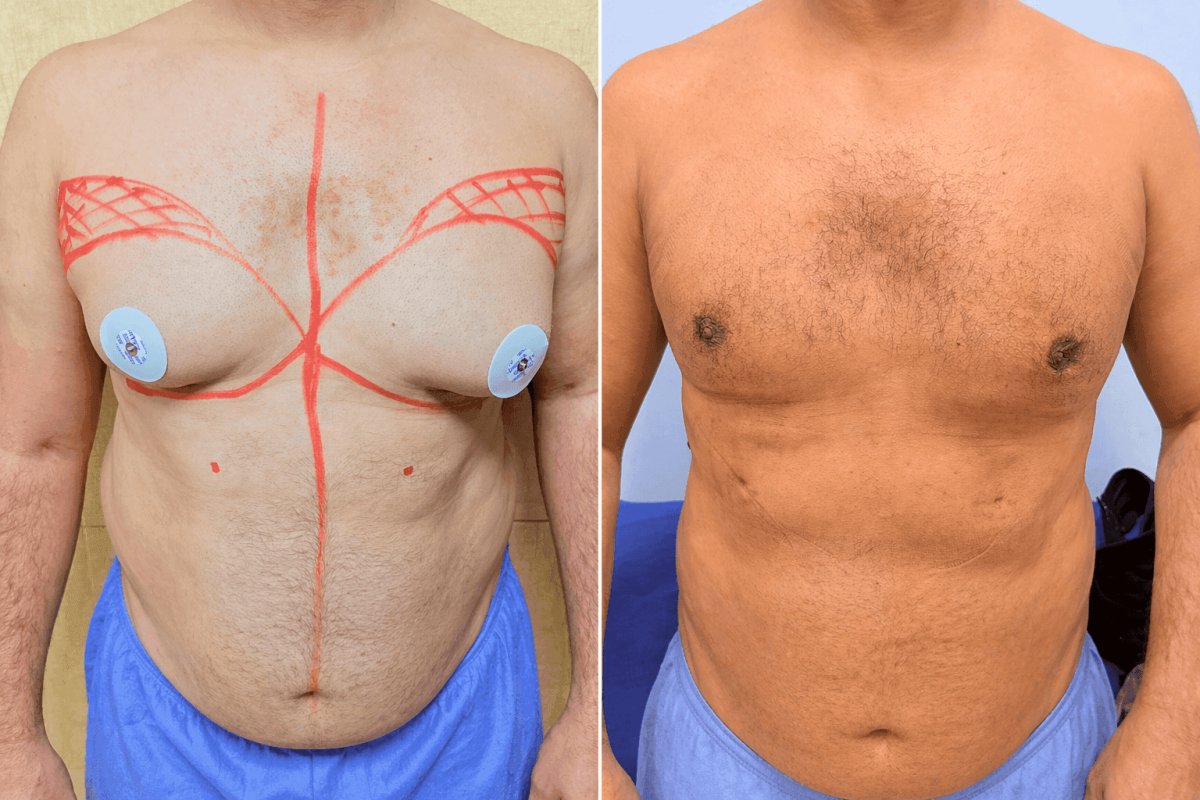 Resultados antes y después de liposucción Vaser para ginecomastia – mejor contorno torácico