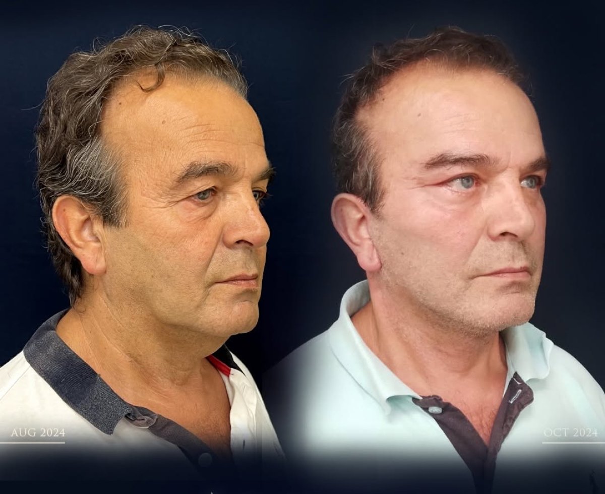 Результаты до и после Deep Plane Facelift у мужчины – заметное омоложение лица