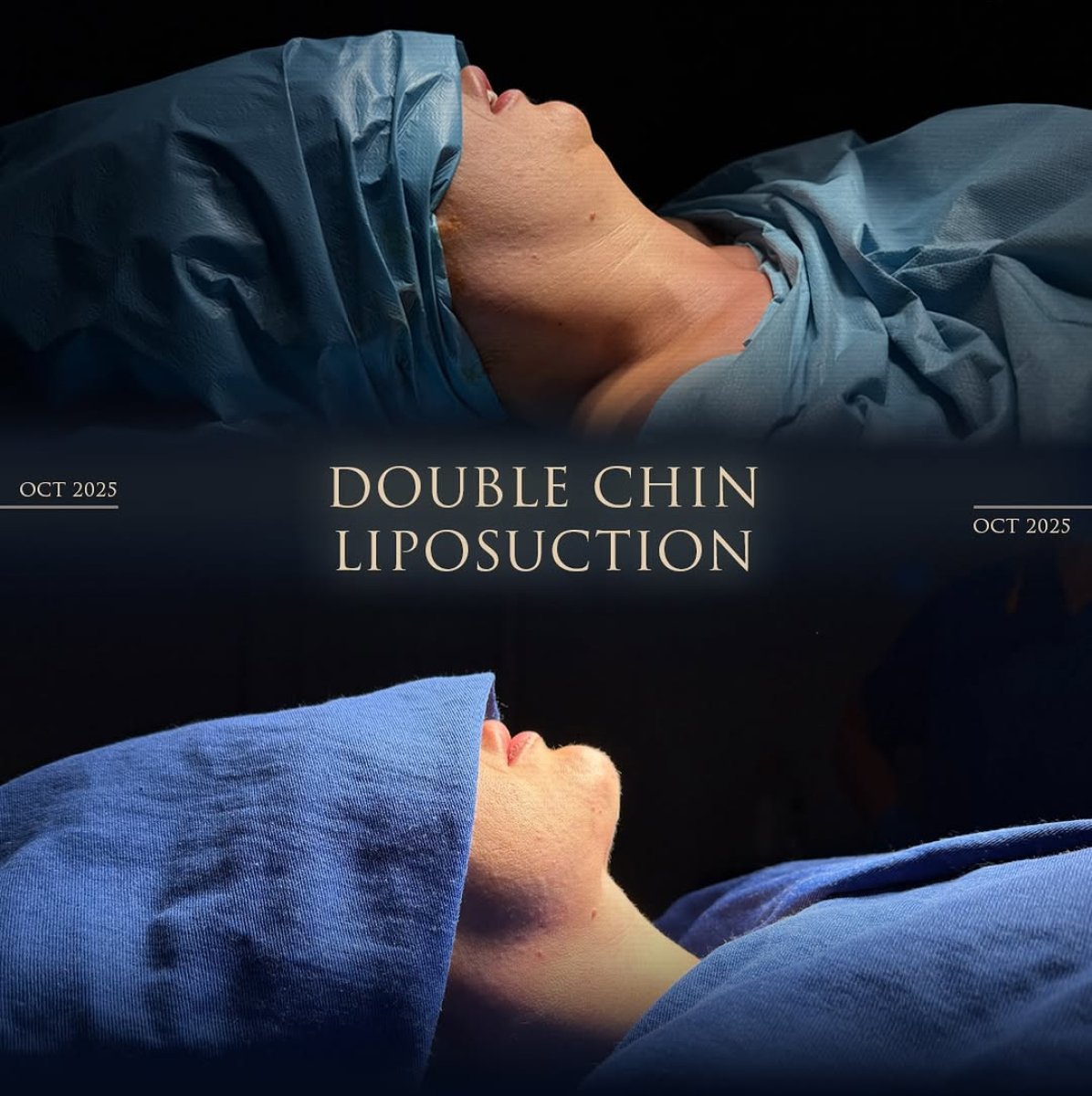 Before and after double chin liposuction results – improved jawline contour visible