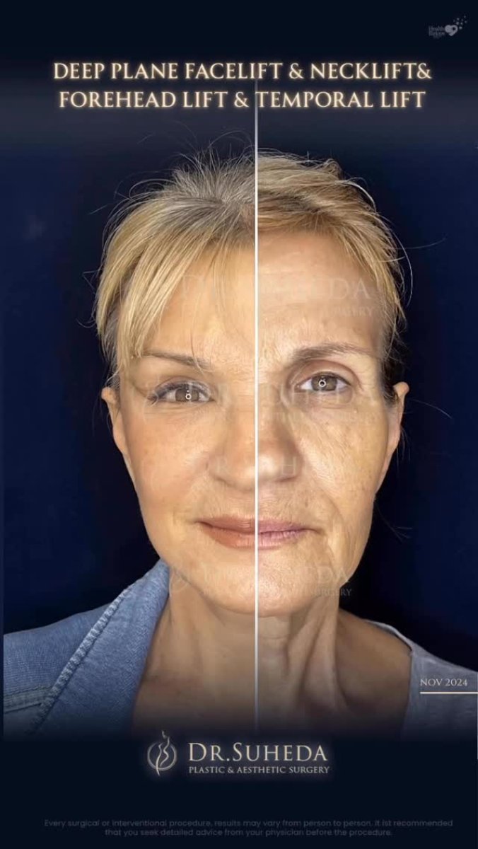 Before and after facelift, neck lift, and forehead lift results at Dr. Suheda clinic