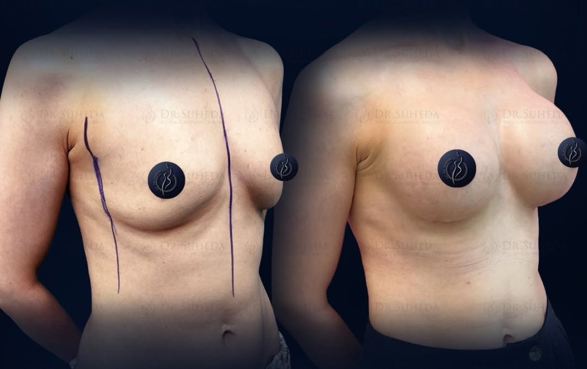 Vorher-nachher-Ergebnis Brustvergrößerung mit Silikonimplantaten in Dr. Suheda Klinik