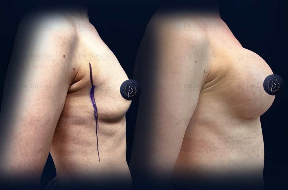 Before and after breast augmentation with silicone implants, visible volume increase result