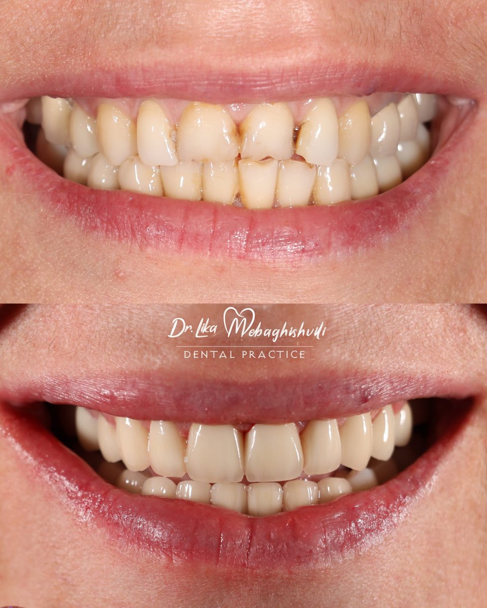 Porcelain veneer before and after results at Dr. Lika Mebaghishvili Dental Practice, smile makeover