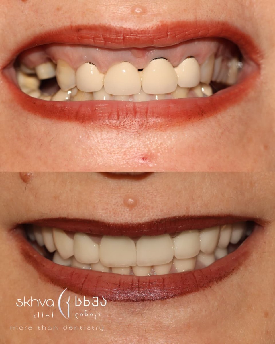 نتائج قبل وبعد جسر الأسنان الزركوني في Skhvadze Clinic – تحسين جمالية الابتسامة