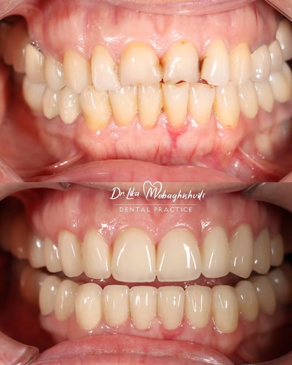 Before and after veneers at Dr. Lika Mebaghishvili Dental Practice – smile transformation result