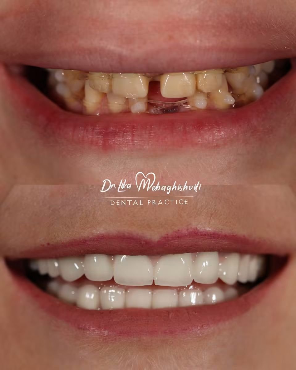 Результаты до и после установки циркониевых коронок в клинике Dr. Lika Mebaghishvili