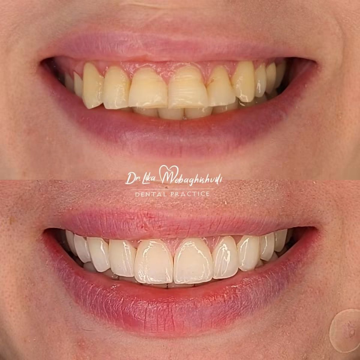 Before and after zirconia crown installation results at Dr. Lika Mebagishvili Dental Practice