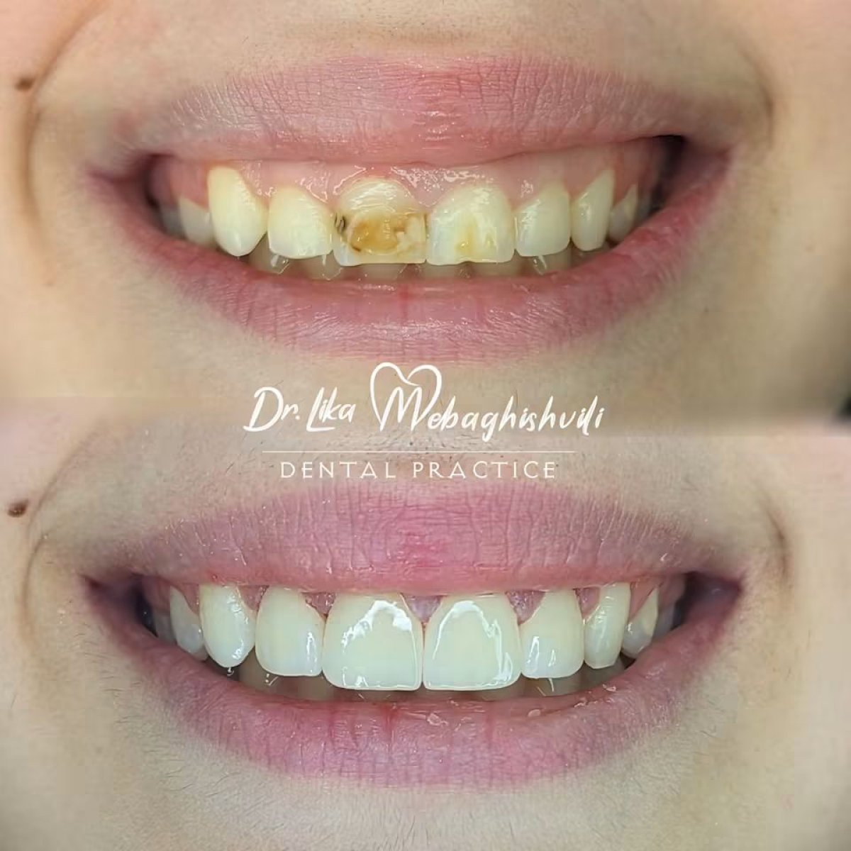 Antes y después de restauración dental en Dr. Lika Mebaghishvili – mejora de dientes frontales