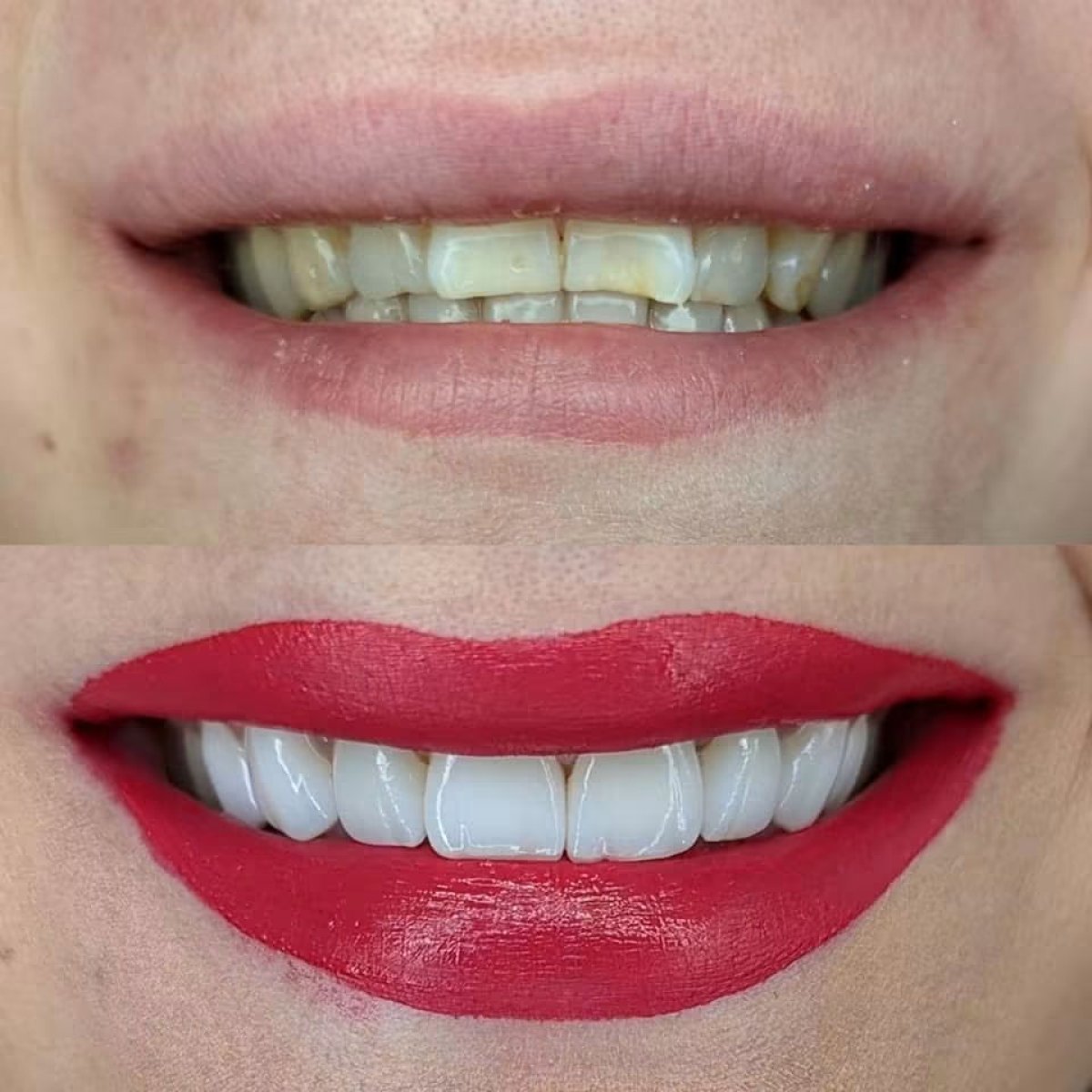 Résultat avant/après facettes dentaires – dents blanches et sourire amélioré