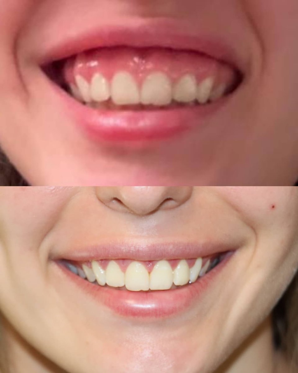 Resultados antes y después de cirugía de encías – sonrisa mejorada y menos encía visible