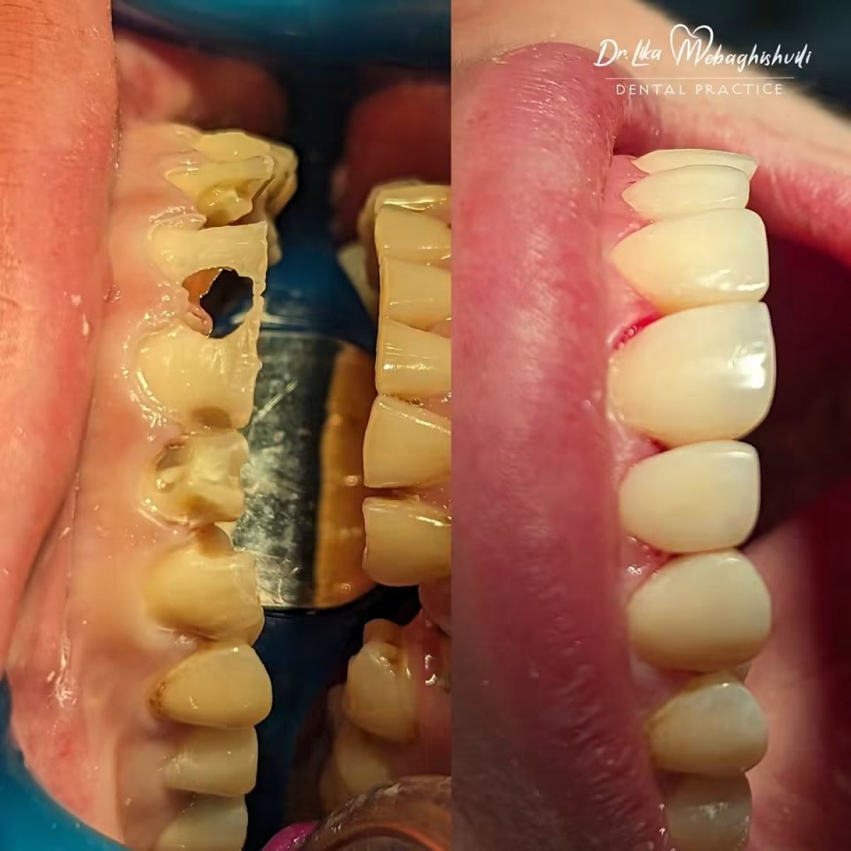 Before and after results of aesthetic composite filling at Dr. Ika Mebaghishvili Dental Practice