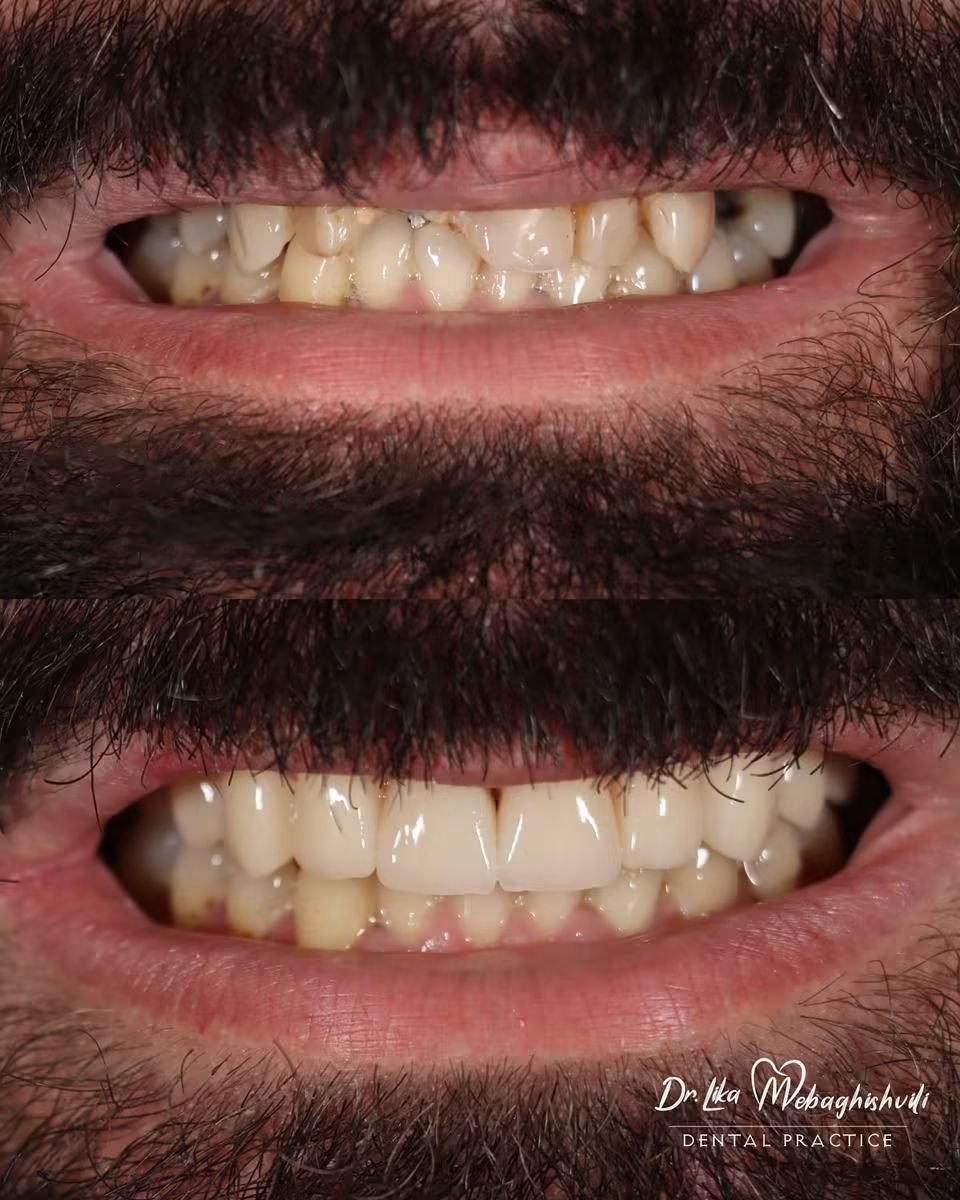 Результаты до и после установки виниров в Dr. Ilka Mebagishvili Dental Practice, преображение улыбки
