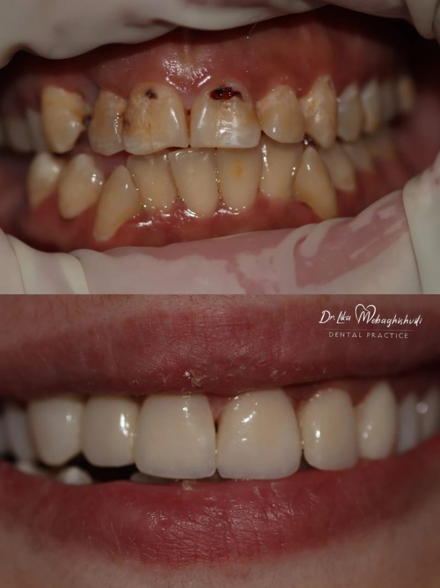 Before and after results of aesthetic composite filling at Dr. Ika Mebagishvili Dental Practice