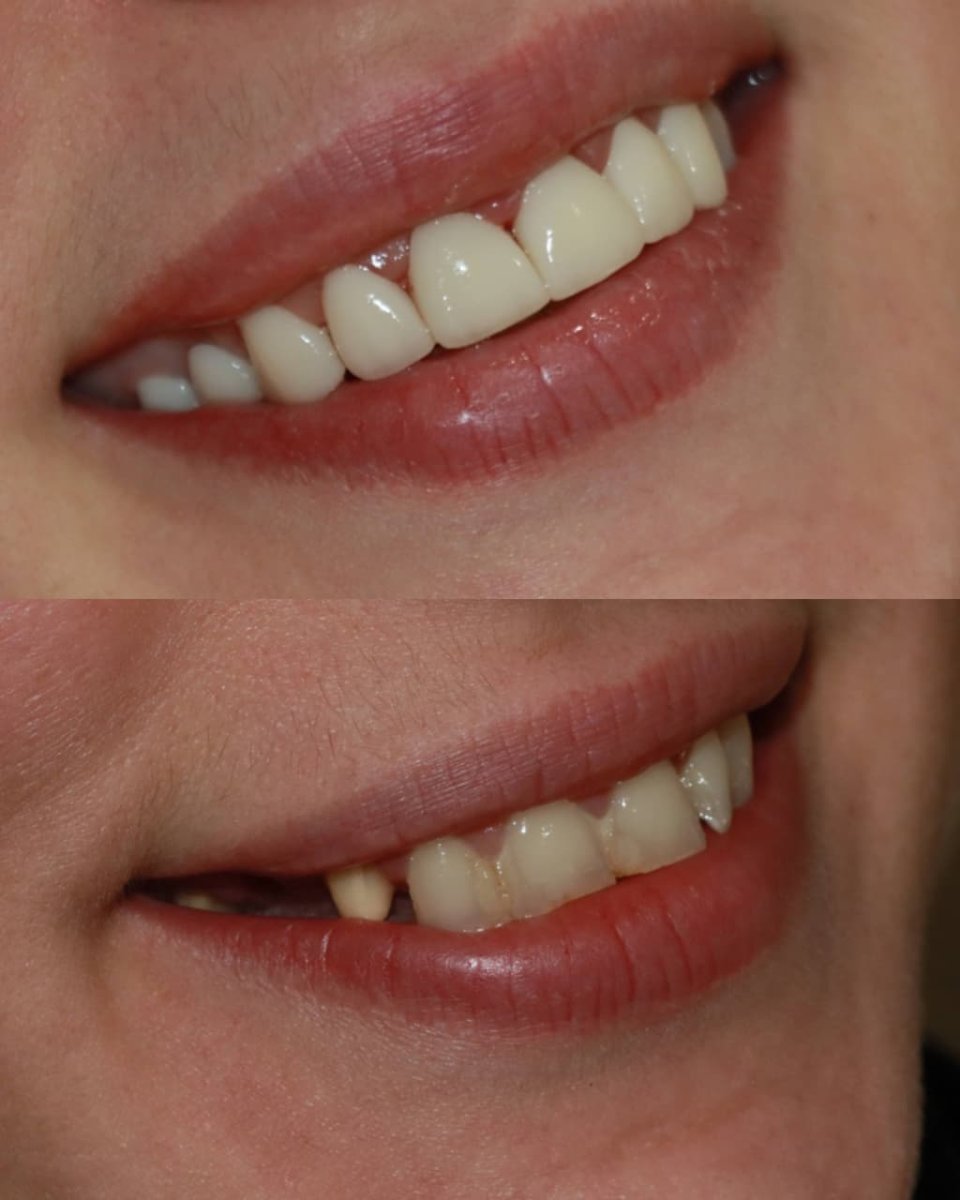 Before and after zirconia veneers result – smile transformation with natural-looking teeth