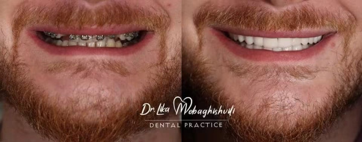 Before and after veneers result at Dr. Lika Mebaghishvili Dental Practice, smile transformation