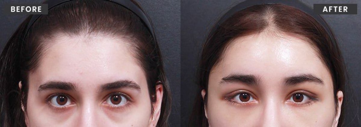 نتائج قبل وبعد Fox Eye Lift في VG Plastic Surgery – رفع وتحسين شكل العينين