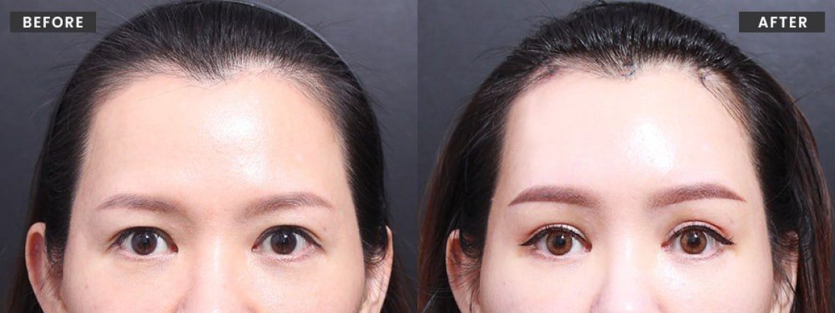Efekty przed i po Fox Eye Lift w VG Plastic Surgery – uniesiony, wydłużony kształt oczu