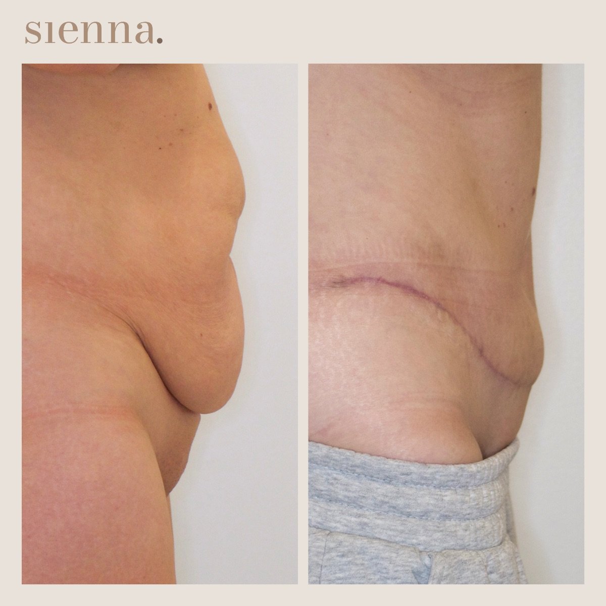 Результаты до и после абдоминопластики и липосакции в Sienna Clinic, улучшенный контур живота