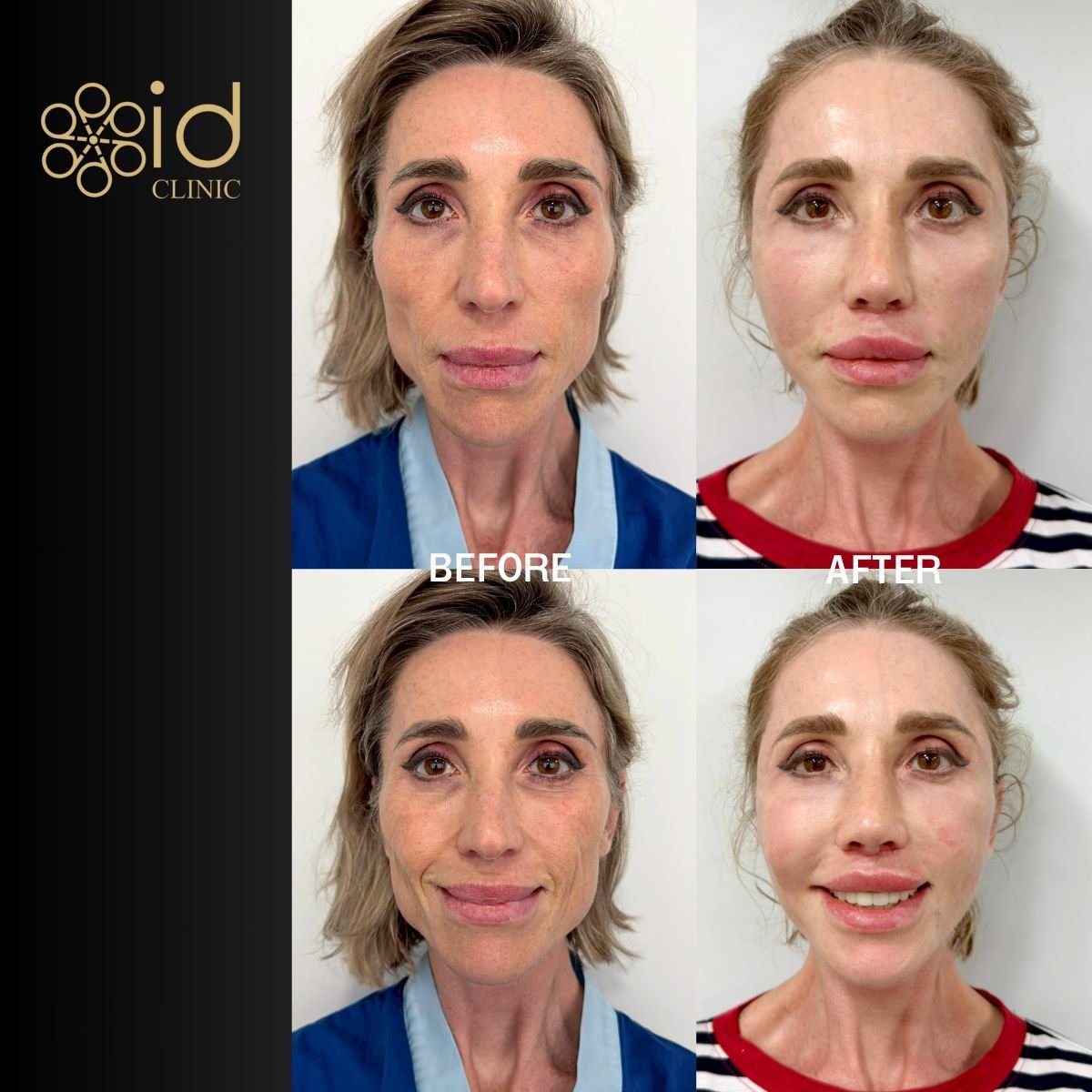 Before and after deep plane facelift results at ID Clinic Bangkok, visible facial rejuvenation
