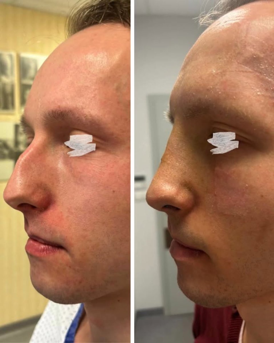 Before and after rhinoplasty results, improved nose shape and profile after nose job