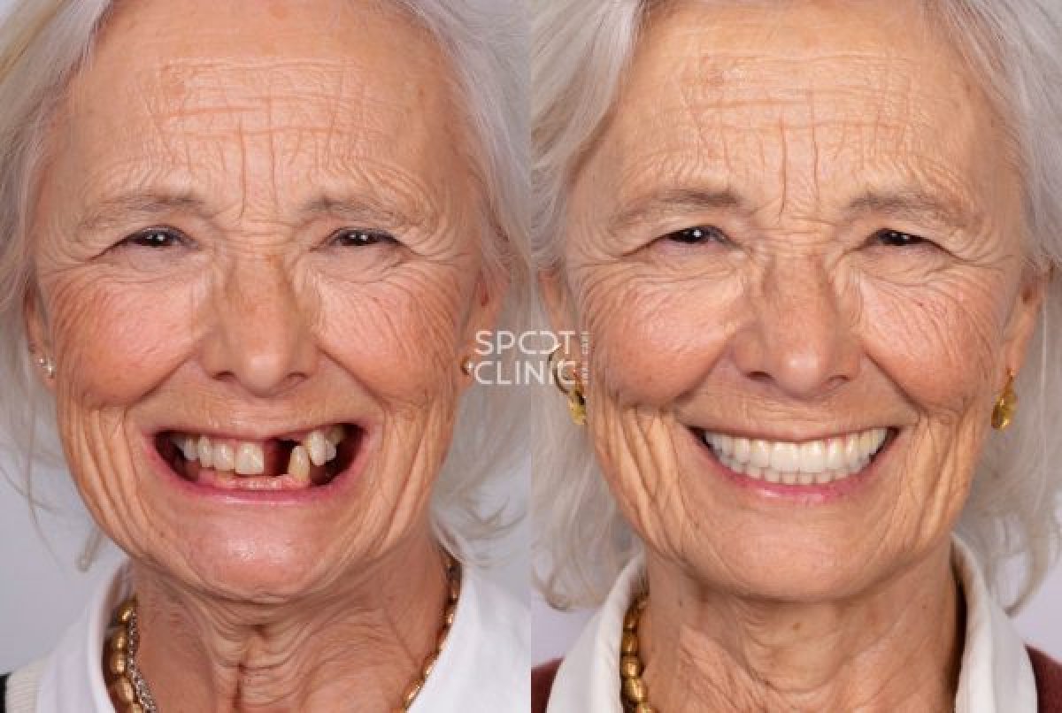 Before and after tooth restoration (bonding) result at Spot Clinic – improved smile aesthetics