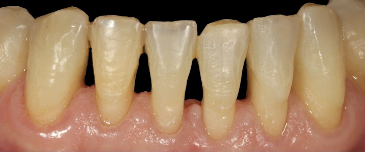 After deep cleaning (scaling and root planing) result – improved gum and teeth health