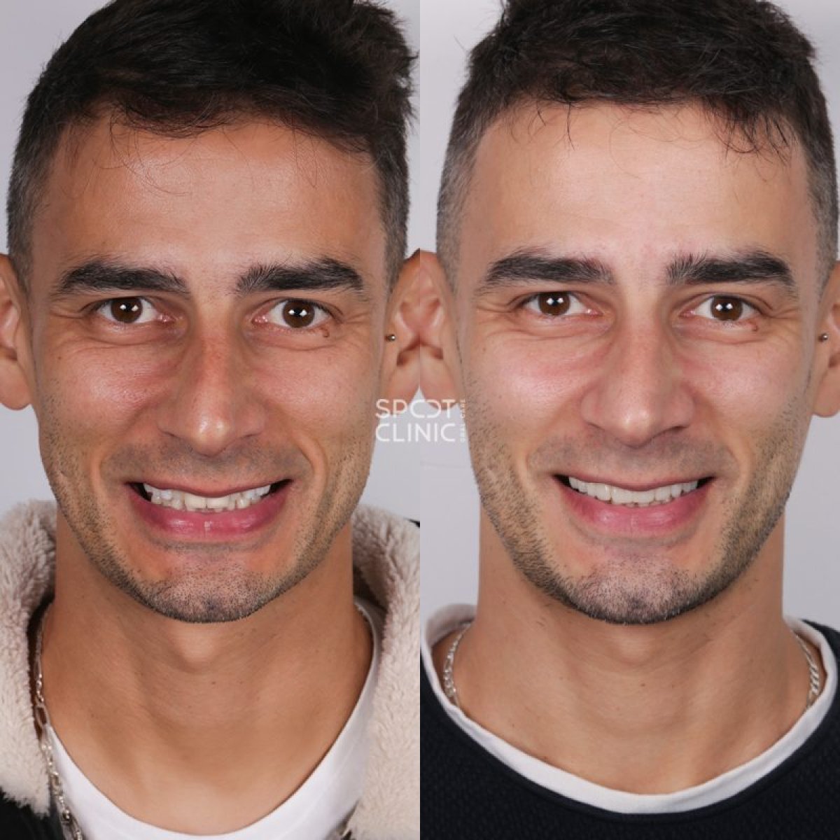 Before and after porcelain veneer results at Spot Clinic – improved smile aesthetics
