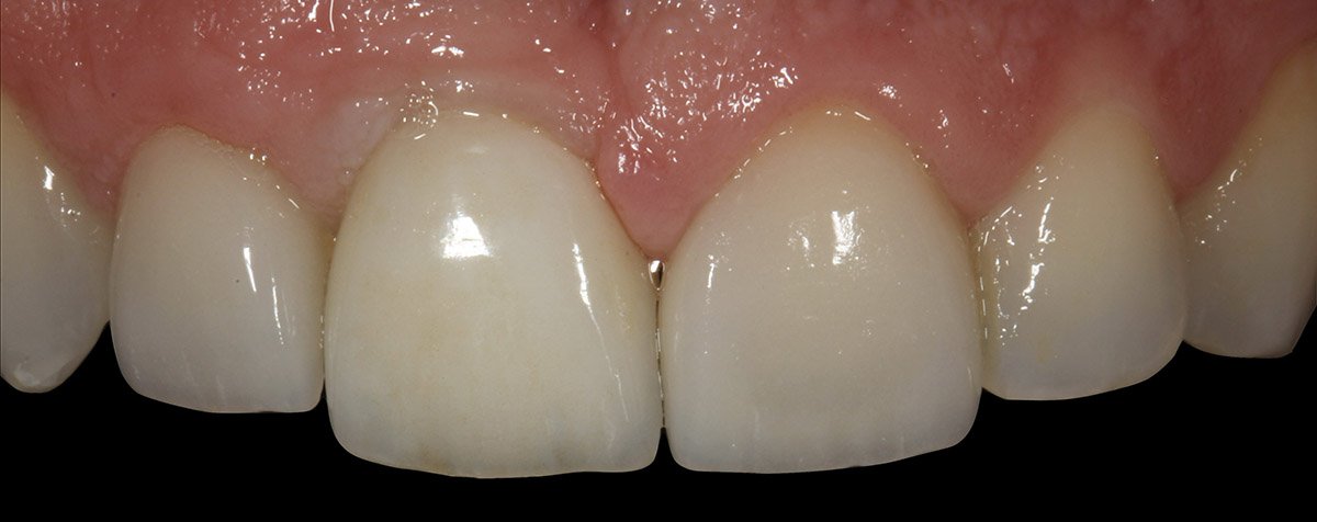 Dental crown installation result on front teeth, improved tooth shape and color