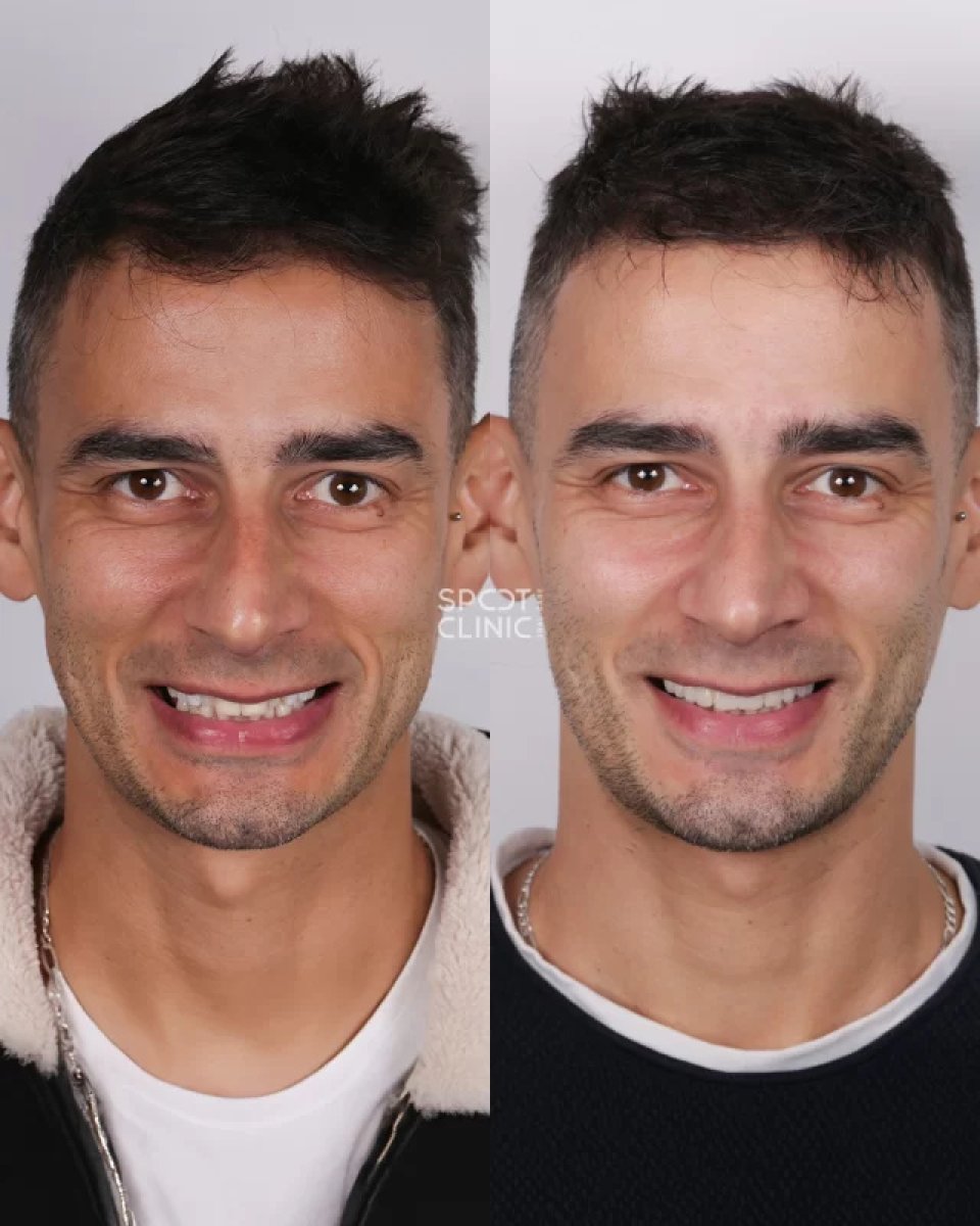 Before and after dental crown installation results at Spot Clinic – improved smile aesthetics