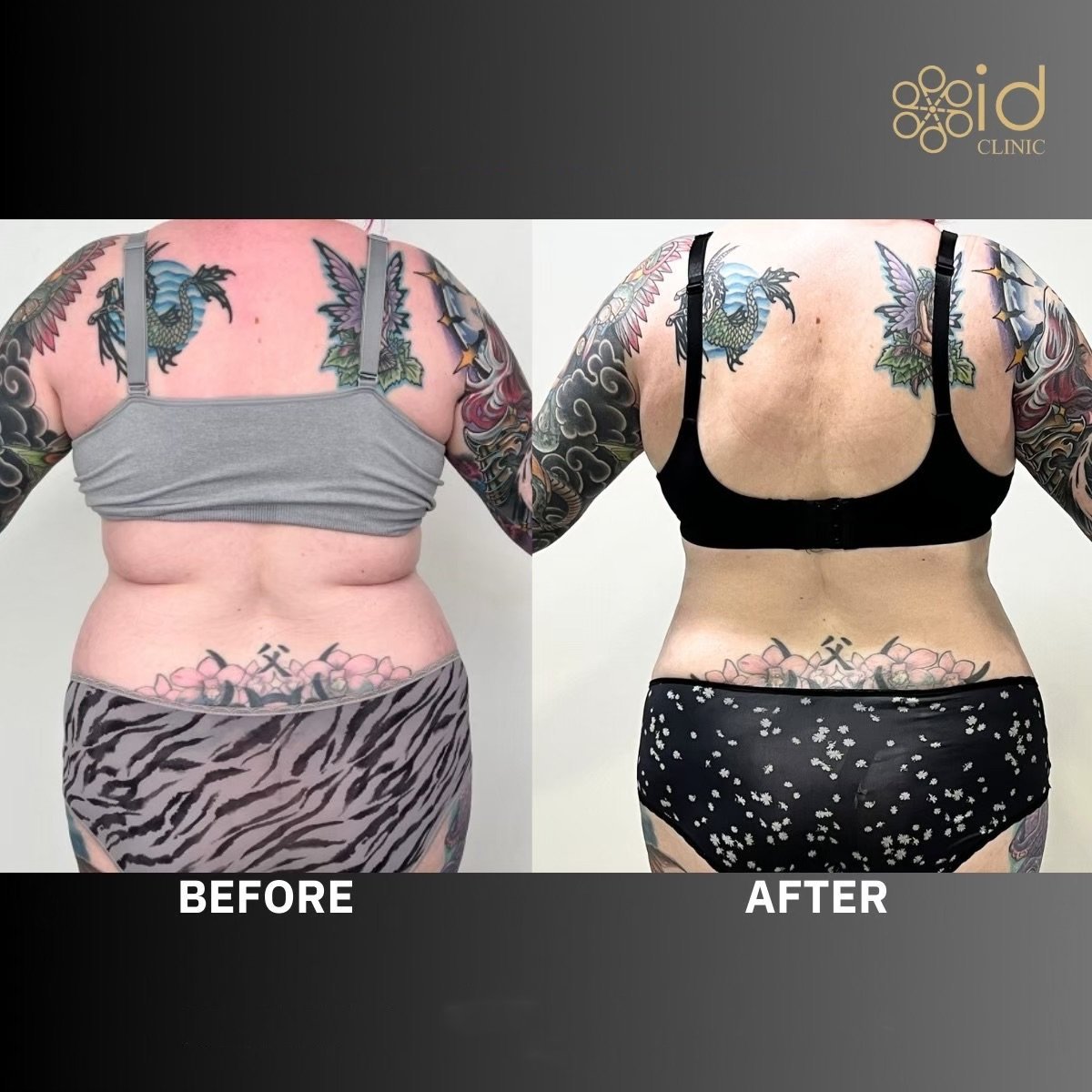 Before and after liposuction results at ID Clinic Bangkok, visible back contour improvement